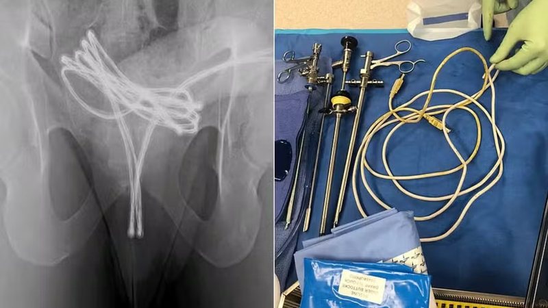 Entenda a prática sexual que deixou homem de 21 anos hospitalizado com cabo USB na uretra