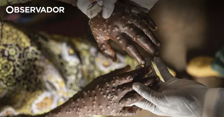 Mais 6 casos de Mpox em Moçambique em 24 horas – Observador