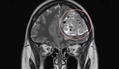 Com dor de cabeça frequente, mulher descobre tumor cerebral de 15 anos