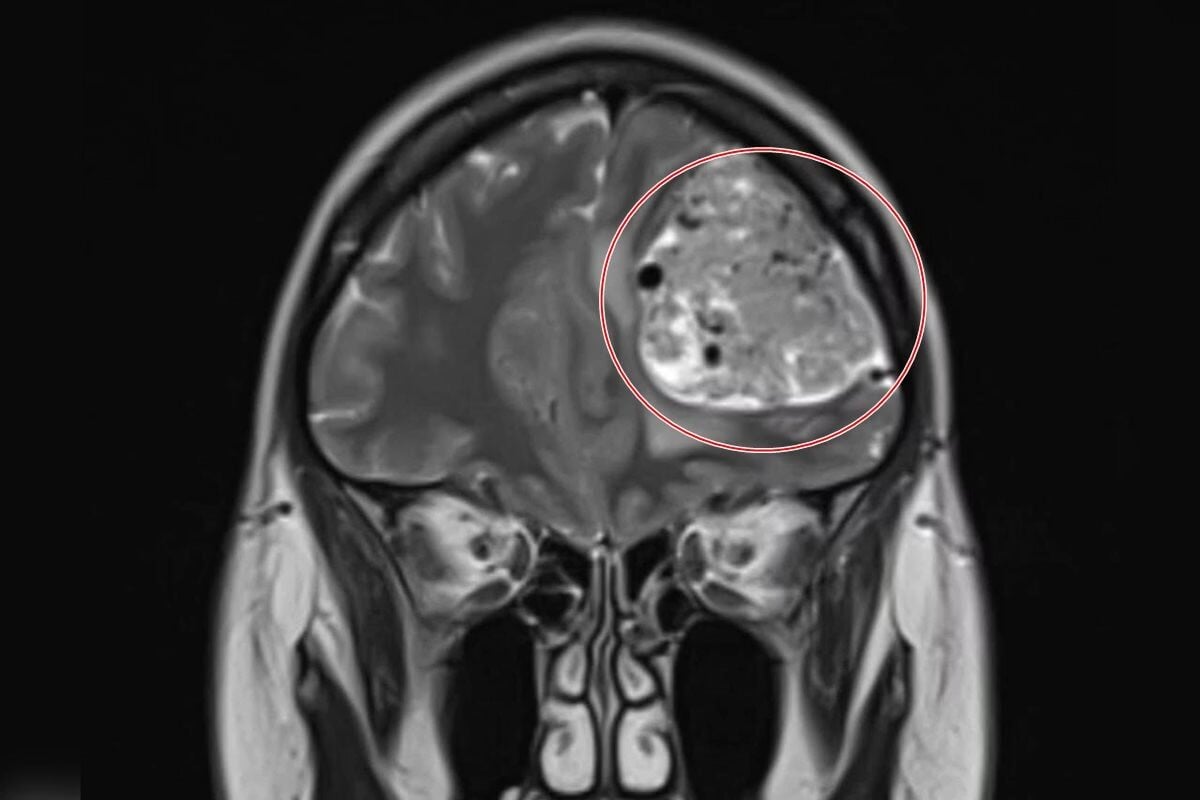 Com dor de cabeça frequente, mulher descobre tumor cerebral de 15 anos