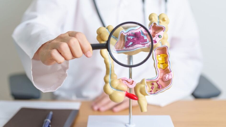 prevenção câncer de intestino