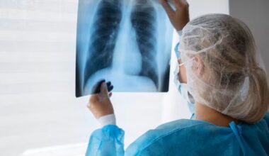 IA brasileira antecipa diagnóstico de câncer de pulmão; conheça