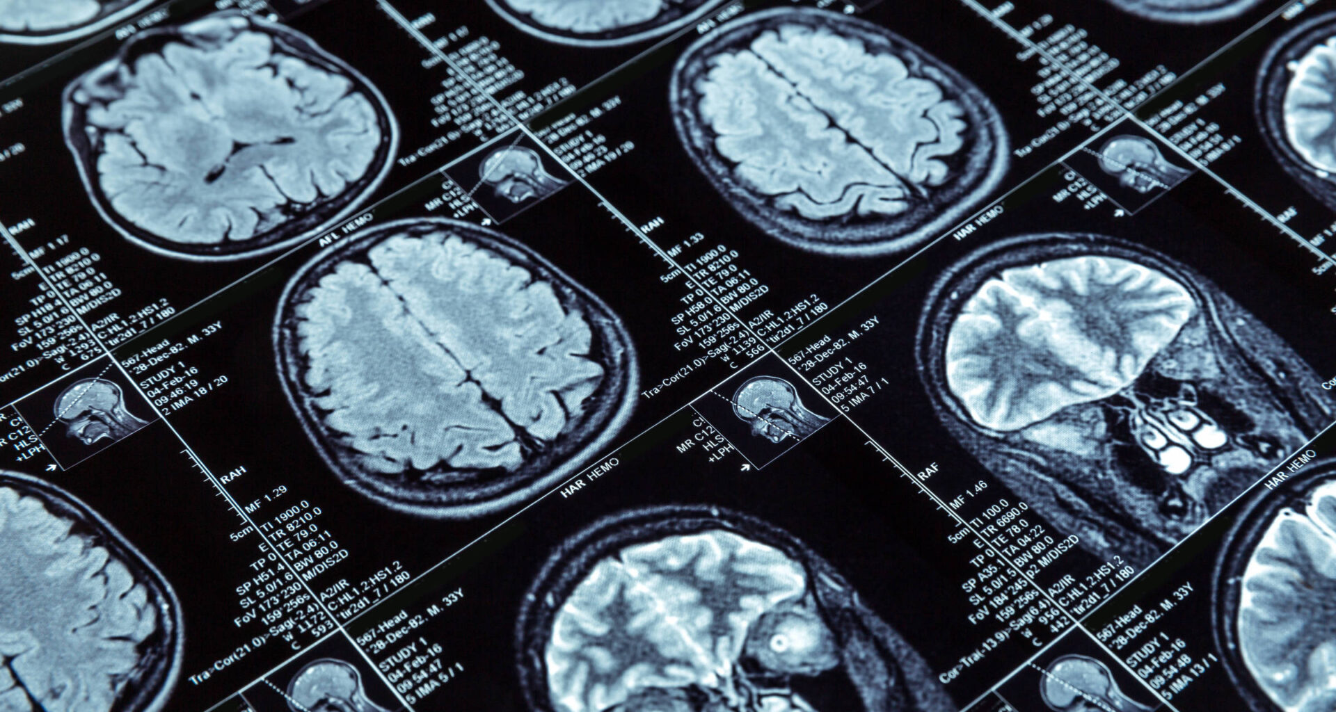 Cinco descobertas promissoras no combate ao Alzheimer 2025 - 28/09/2025 - Equilíbrio e Saúde