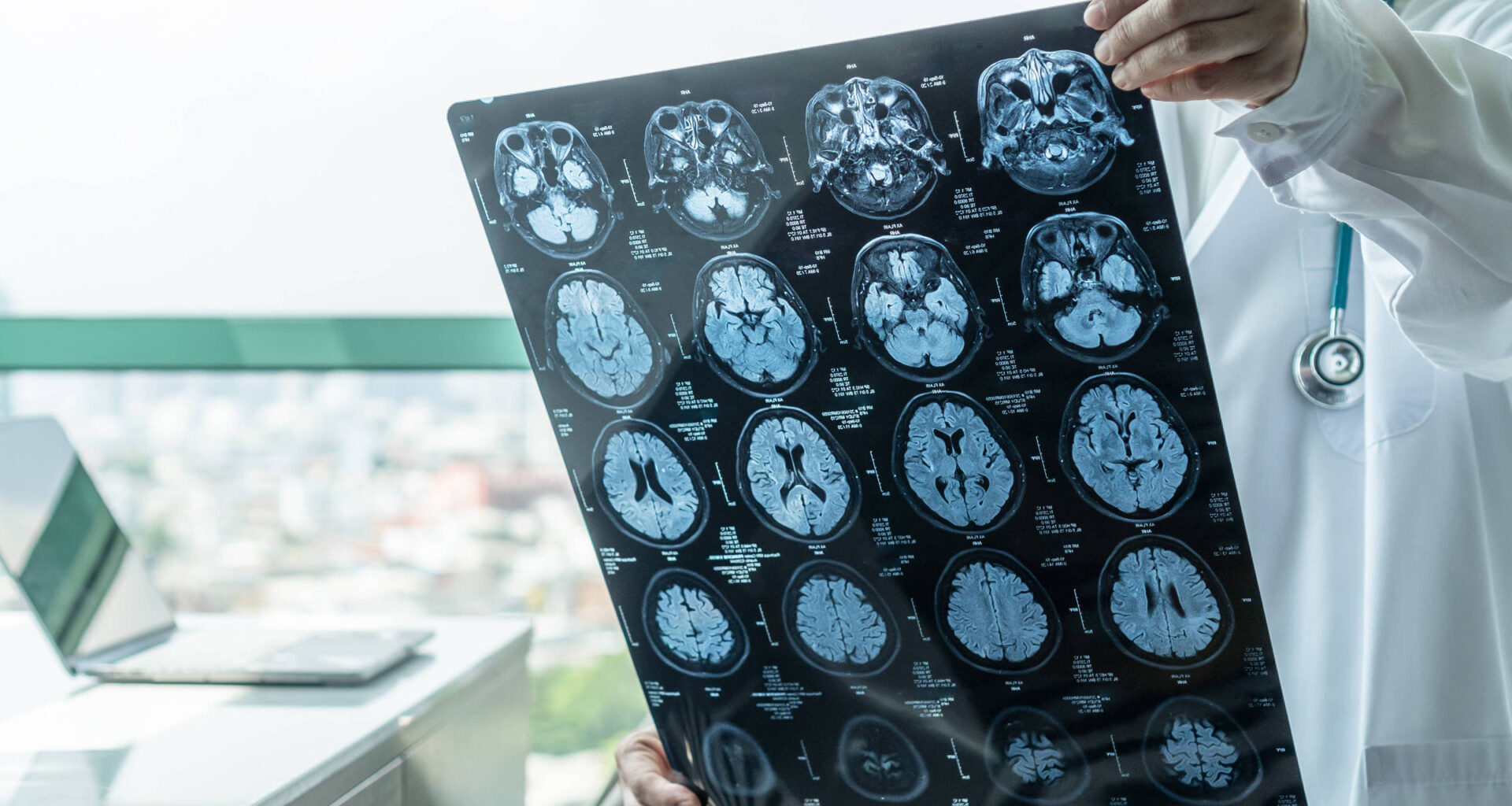 Medicamento para tumores cerebrais reduz risco em 61% - 05/09/2025 - Equilíbrio e Saúde