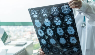 Medicamento para tumores cerebrais reduz risco em 61% - 05/09/2025 - Equilíbrio e Saúde