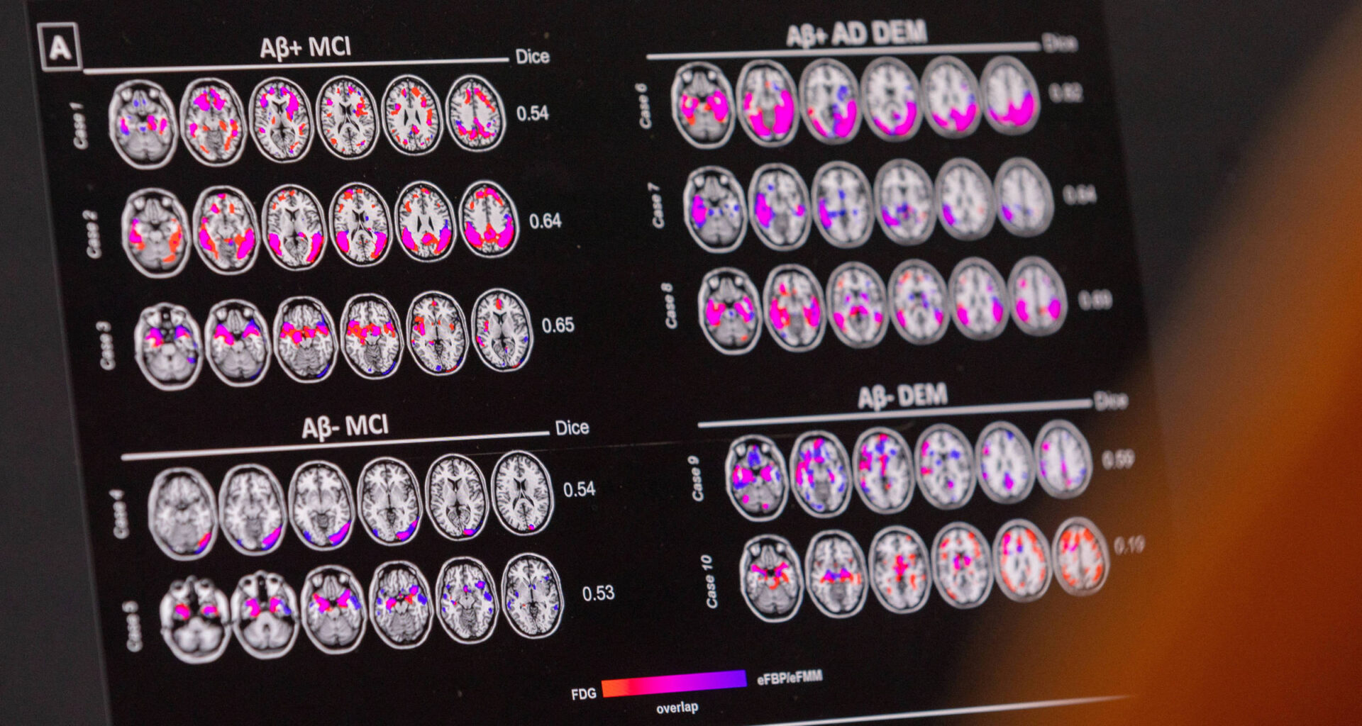 Novo medicamento para Alzheimer inicial chega ao Brasil - 01/09/2025 - Equilíbrio e Saúde