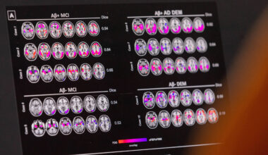 Novo medicamento para Alzheimer inicial chega ao Brasil - 01/09/2025 - Equilíbrio e Saúde