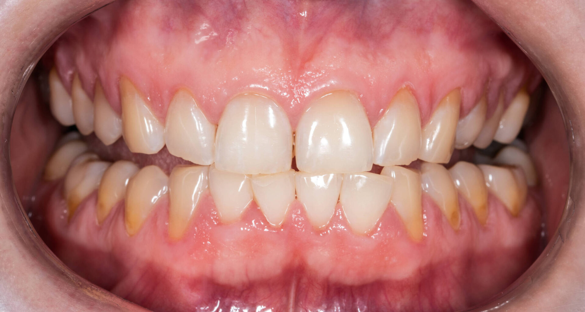 Retração gengival causa sensibilidade e até perda de dente - 03/09/2025 - Equilíbrio e Saúde