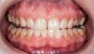 Retração gengival causa sensibilidade e até perda de dente - 03/09/2025 - Equilíbrio e Saúde