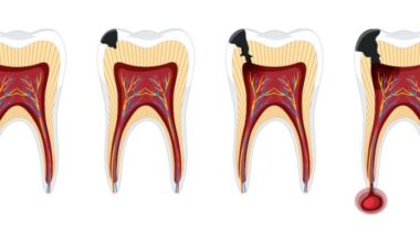 Exercício físico mais ômega-3 reduzem infecção na raiz do dente