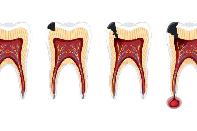Exercício físico mais ômega-3 reduzem infecção na raiz do dente