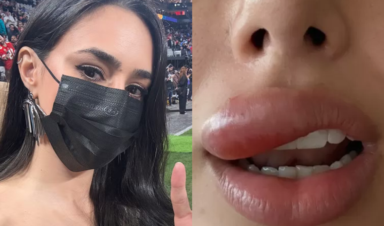 Médicas explicam problema de saúde que inchou a boca de Bruna Biancardi: ‘Pode evoluir para uma meningite ou outra complicação maior’.