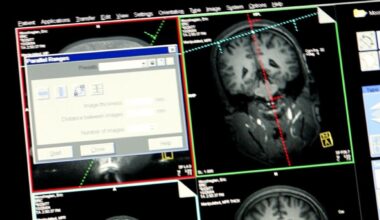 Como diagnosticar a Esclerose Múltipla, doença autoimune que atinge mais mulheres jovens
