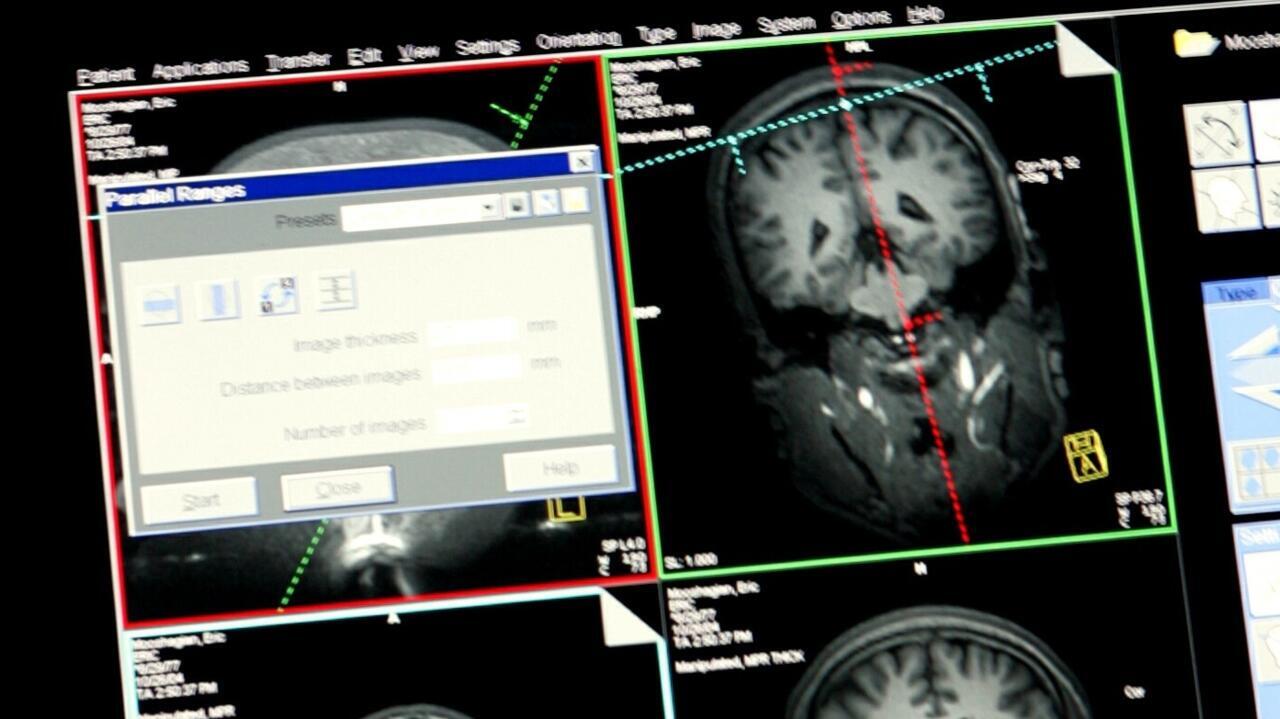 Como diagnosticar a Esclerose Múltipla, doença autoimune que atinge mais mulheres jovens