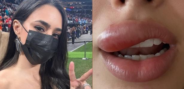 Bruna Biancardi mostra evolução de sua celulite facial