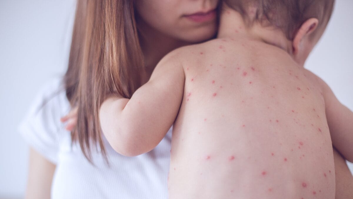 casos de sarampo aumentaram nas américas