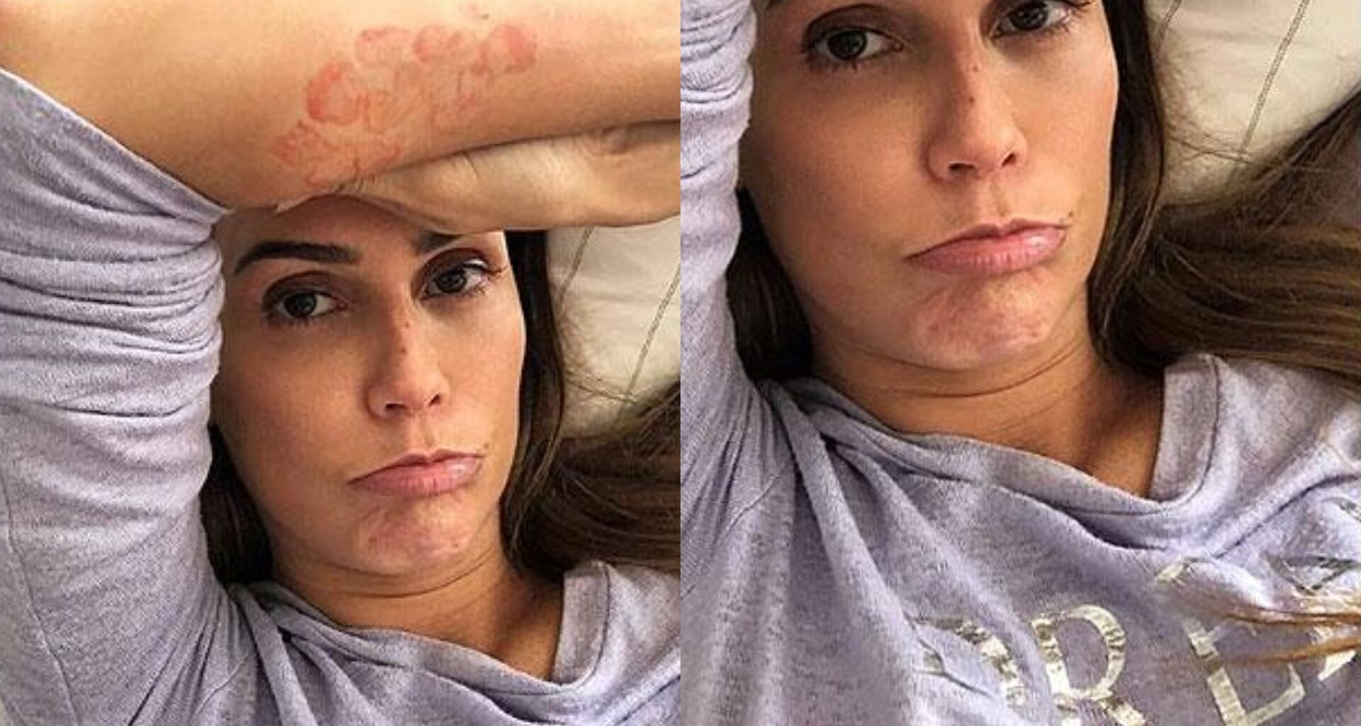 Deborah Secco fez alerta em uma campanha de conscientização da Urticária Crônica Espontânea (UCE)