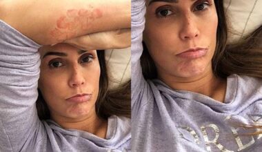Deborah Secco fez alerta em uma campanha de conscientização da Urticária Crônica Espontânea (UCE)