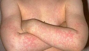 Saiba o que é o eritema infeccioso, conhecido como síndrome da bochecha vermelha