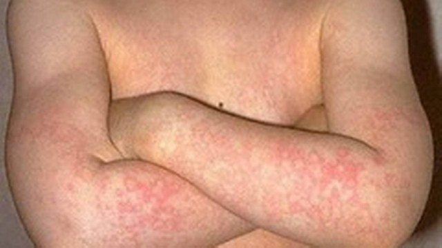 Saiba o que é o eritema infeccioso, conhecido como síndrome da bochecha vermelha