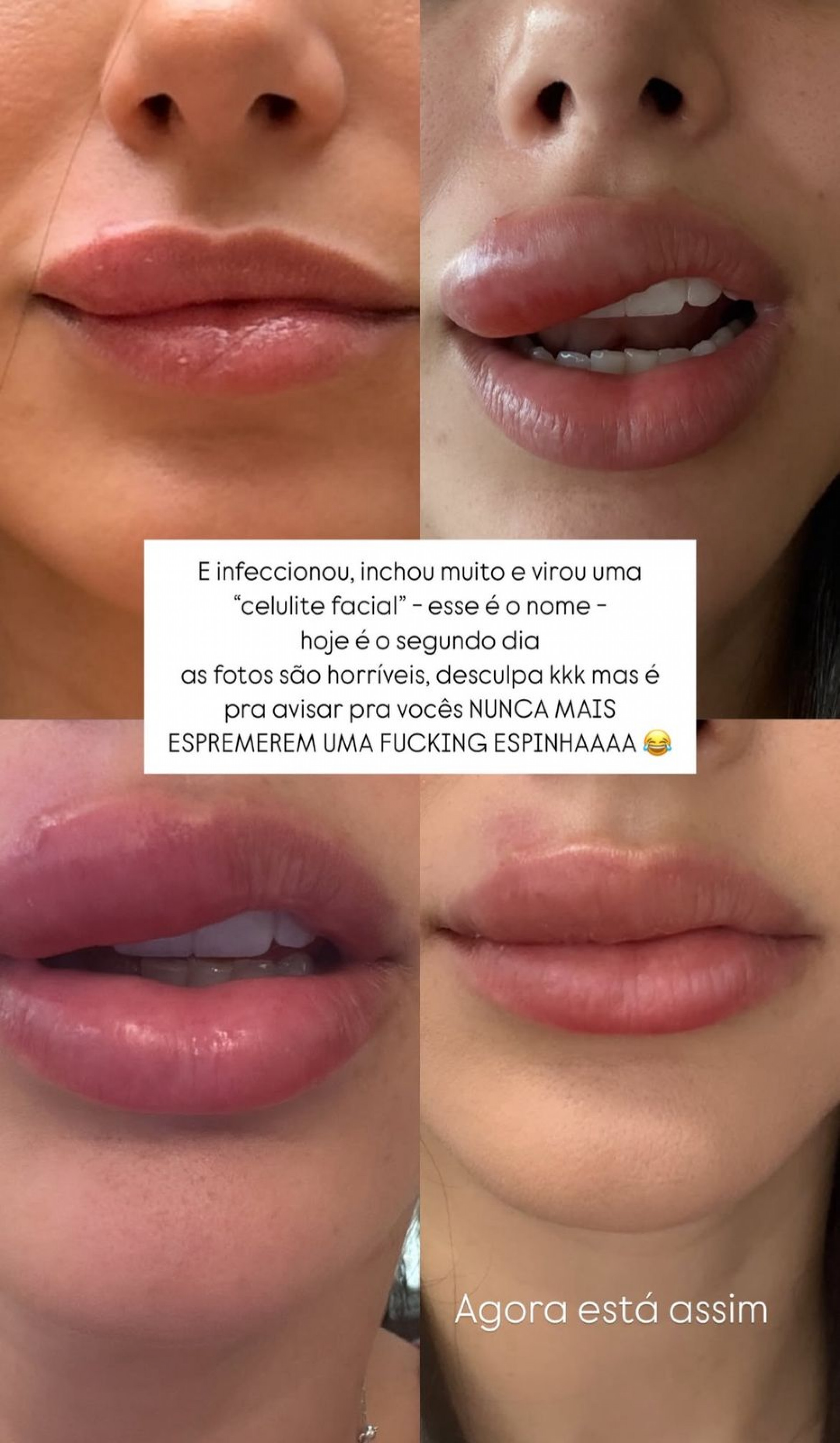 Influenciadora mostrou inchaço na região do rosto - Reprodução / Instagram