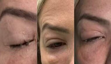Apresentadora é diagnosticada com celulite ocular em Santos e faz alerta; conheça a doença - A Tribuna