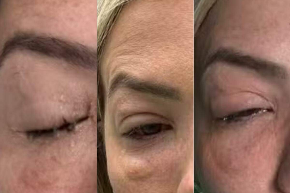 Apresentadora é diagnosticada com celulite ocular em Santos e faz alerta; conheça a doença - A Tribuna
