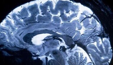 OMS pede atenção urgente à saúde cerebral