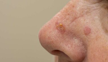 Queratose actínica: saiba os sinais, riscos e prevenção do câncer de pele - Ser Saúde