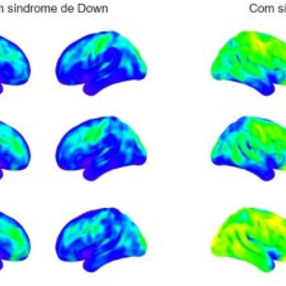Neuroinflamação em síndrome de Down explica alta prevalência de Alzheimer