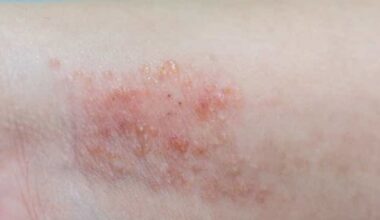 Pesquisadores do CTS-Cevap desenvolvem novo medicamento para doenças da pele