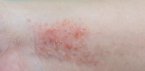 Pesquisadores do CTS-Cevap desenvolvem novo medicamento para doenças da pele