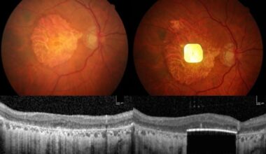 Minúsculo implante ocular assistido por IA ajuda cegos a voltar a ver