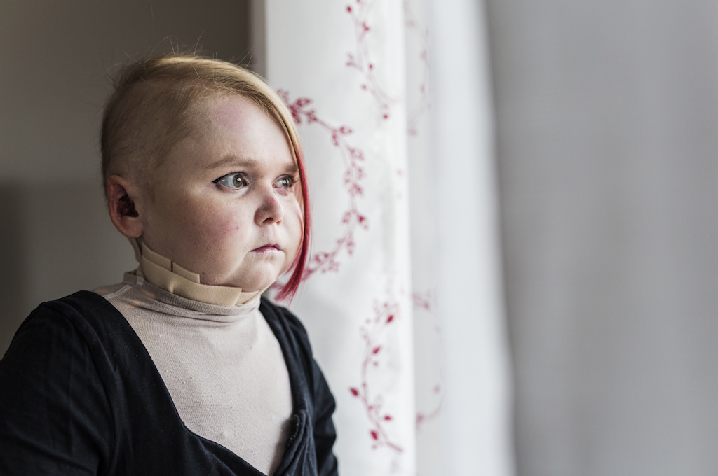 Gene da longevidade de supercentenários reverte danos cardíacos em crianças com progeria