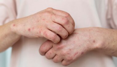 Casos de sarampo voltam a crescer e acendem alerta no Brasil