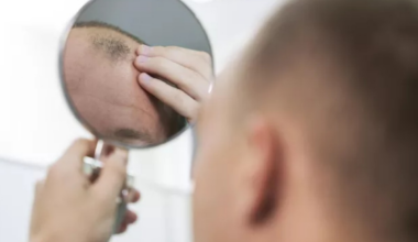relação de remédio de calvície e saúde mental foi ignorada por 20 anos, diz estudo