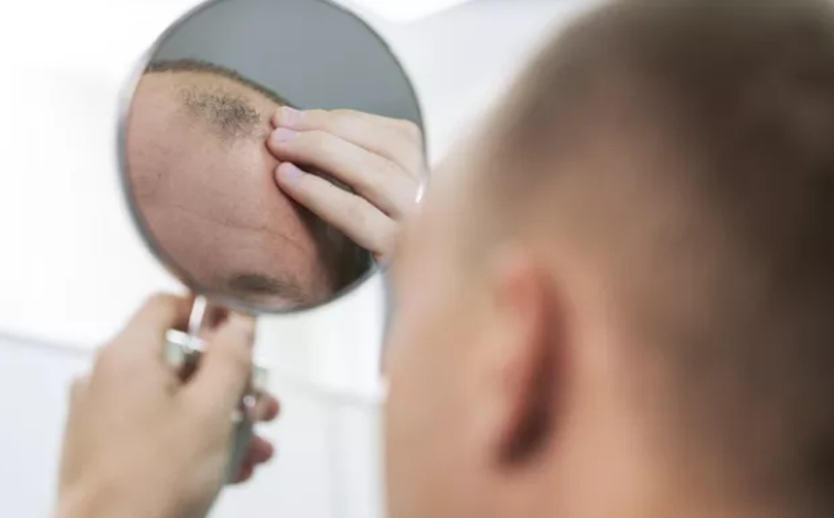 relação de remédio de calvície e saúde mental foi ignorada por 20 anos, diz estudo