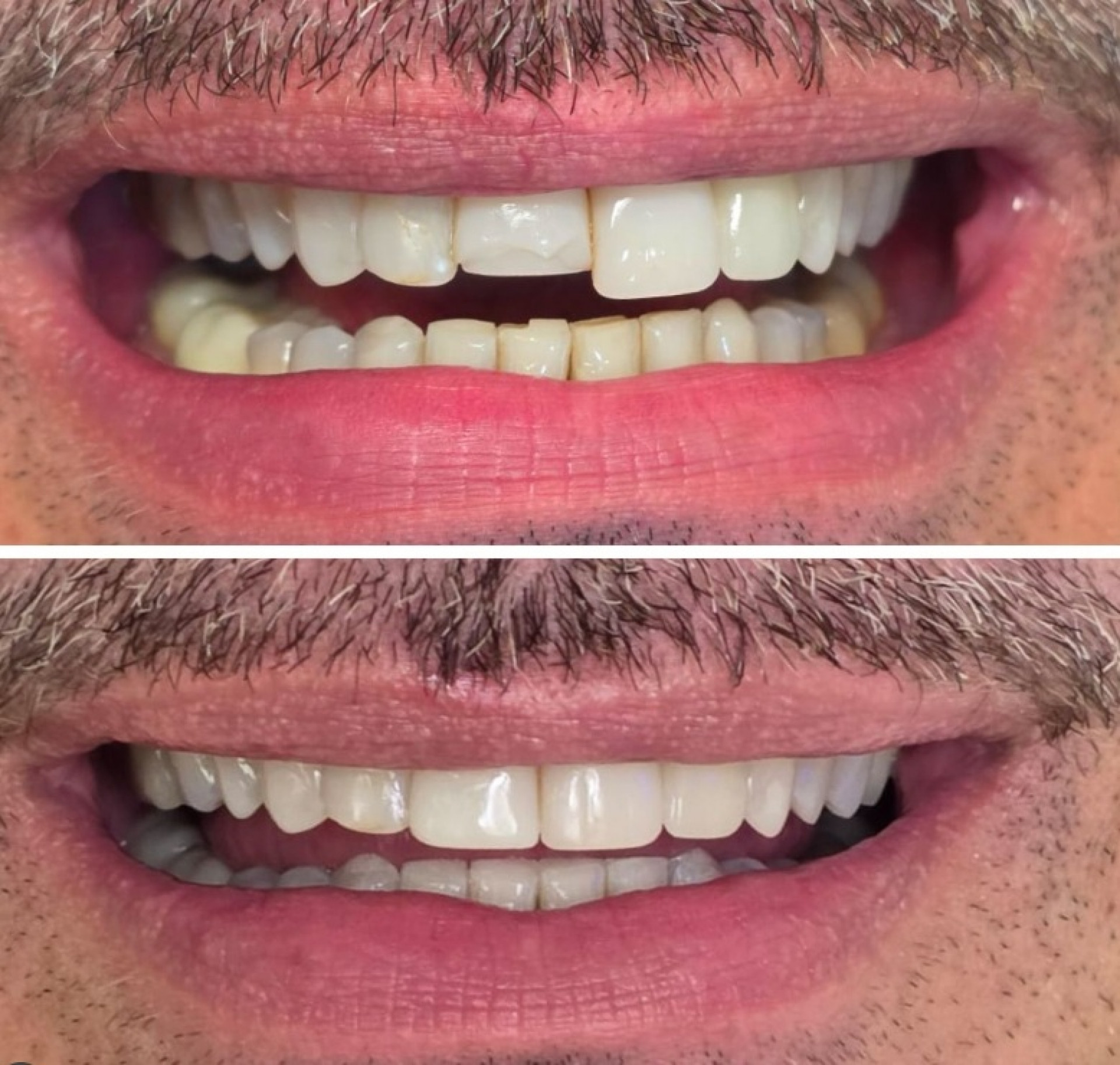 Carmo Dalla Vecchia mostra o antes e depois do seu sorriso - Reprodução/Instagram