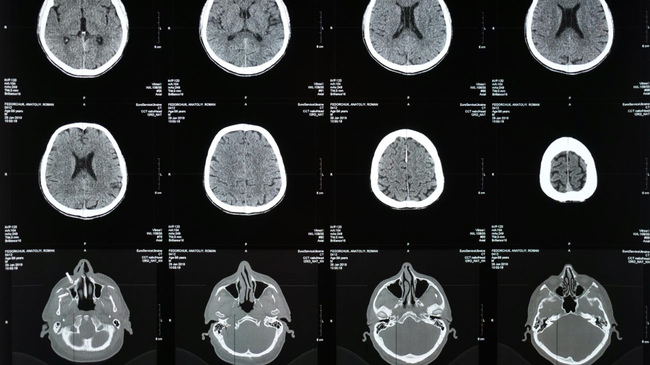A pesquisa acompanhou mais de 13 mil adultos com 45 anos ou mais durante 15 anos