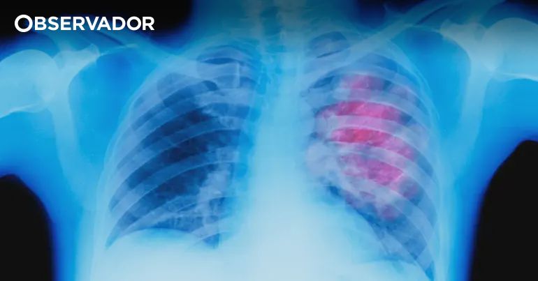 Estudo nacional vai determinar impacto da DPOC – Observador