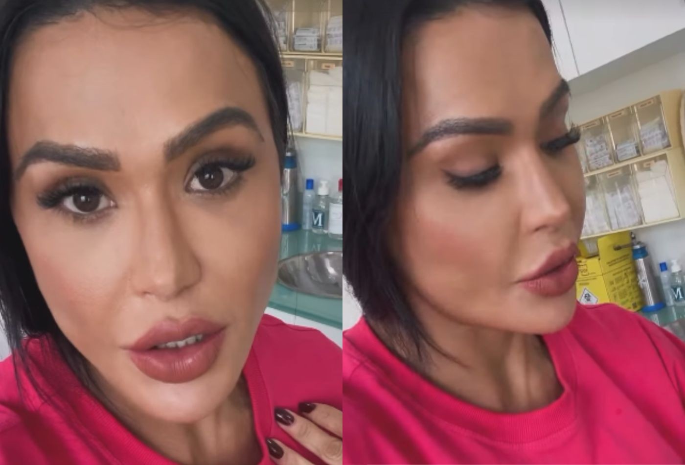 Gracyanne Barbosa mostra recuperação do joelho e retirada de pontos 14 dias após a cirurgia; vídeo