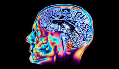 Poderá o lítio ser utilizado para prevenir a doença de Alzheimer?