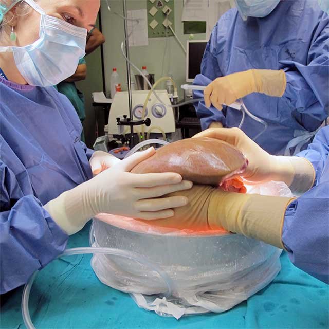 Homem sobrevive quase seis meses com transplante de fígado de porco na China