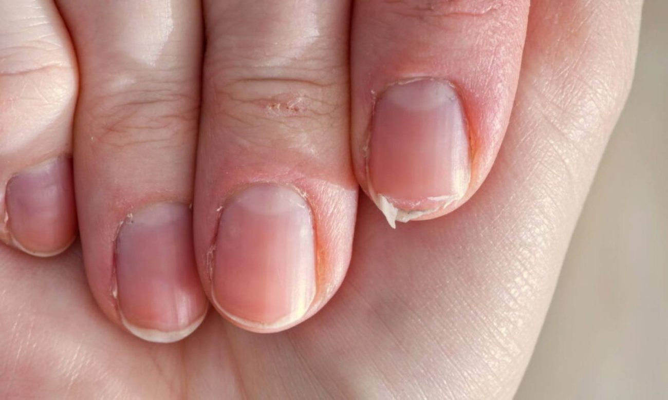 Unhas fracas e quebradiças também pode ser um sinal de uso excessivo de esmaltes, removedores com acetona e contato frequente com produtos de limpeza