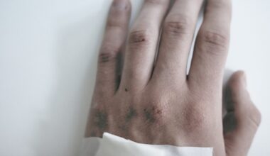 De Uganda à Europa: nova cepa de mpox já circula em seis países fora da África