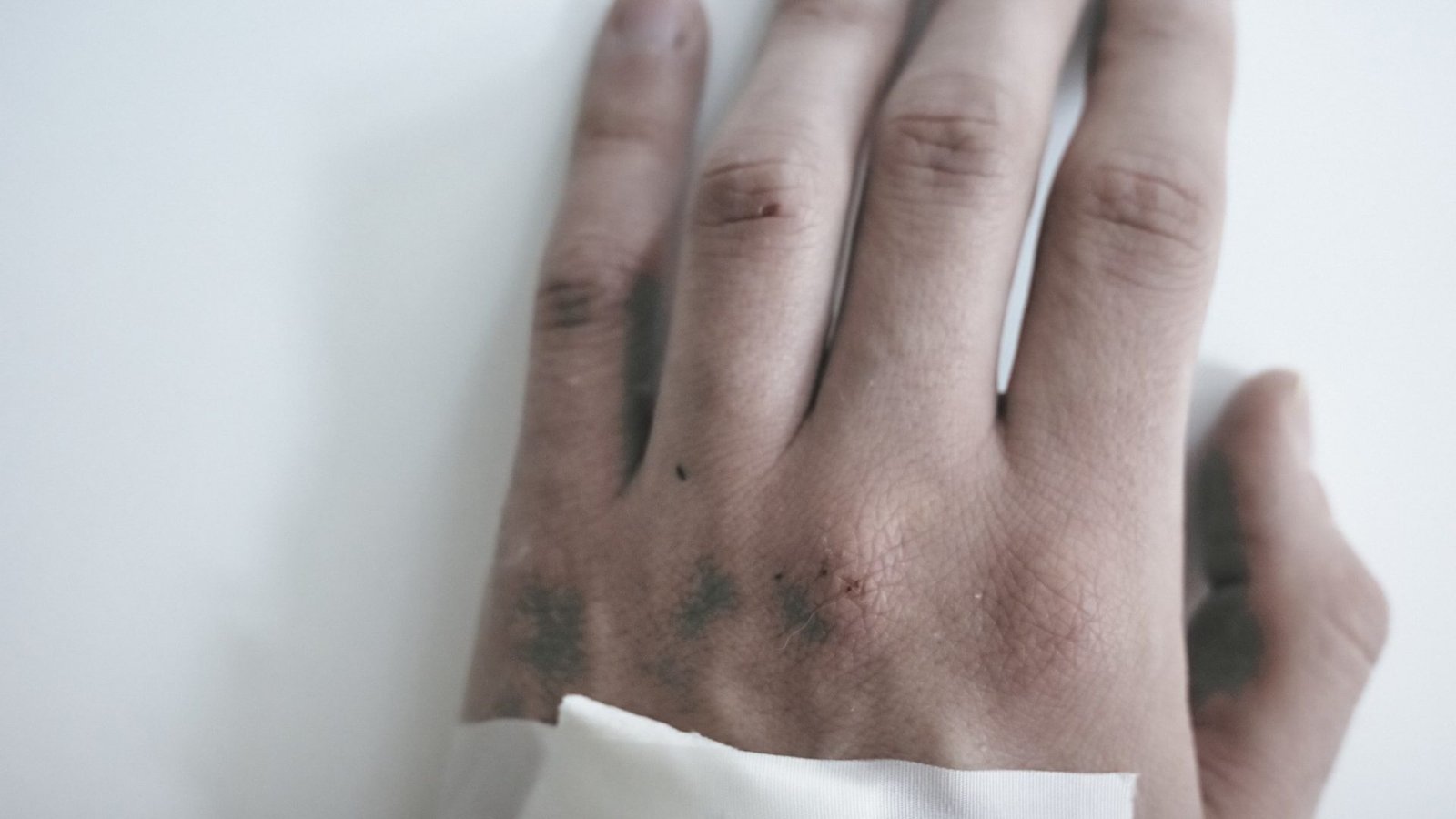 De Uganda à Europa: nova cepa de mpox já circula em seis países fora da África