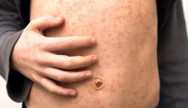 Canadá perde estatuto de eliminação do sarampo após quase 30 anos