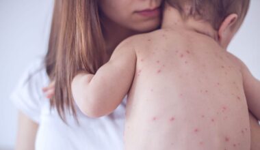 Casos de sarampo sobem 47% na Europa e Ásia Central no ano passado, diz a OMS