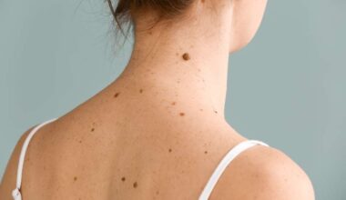 Saiba como usar a regra do ABCDE para avaliar pintas e manchas na pele - Ser Saúde