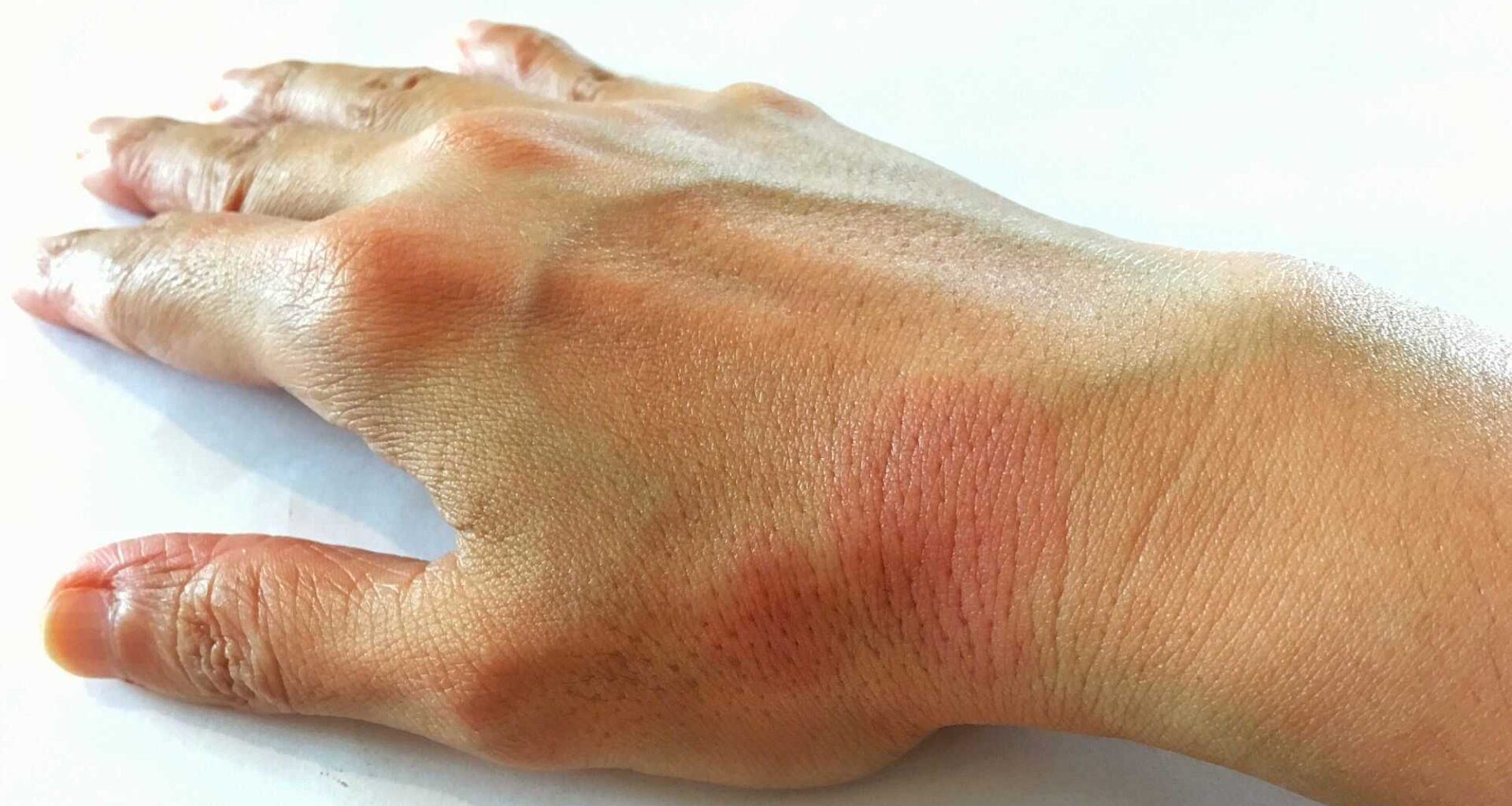 Vírus comum pode ser a chave do lúpus, dizem cientistas